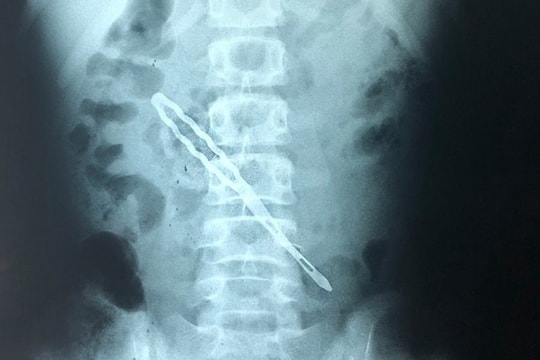 Bé gái thủng ruột vì nuốt kẹp tóc