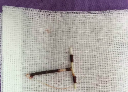 Vòng tránh thai đi lạc trong ổ bụng người phụ nữ