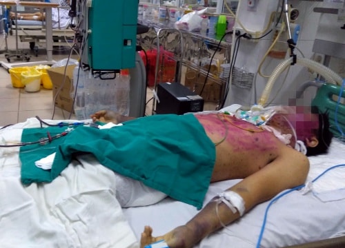 Dùng sai thuốc trị thủy đậu, thanh niên 28 tuổi nguy kịch