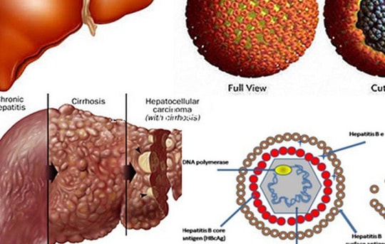 5 nhóm đối tượng dễ mắc ung thư gan