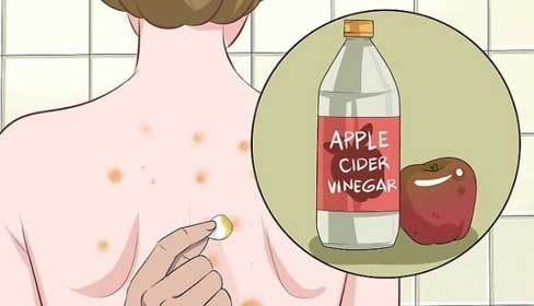 Công thức trị mụn lưng hiệu quả với giấm táo và tinh dầu tràm