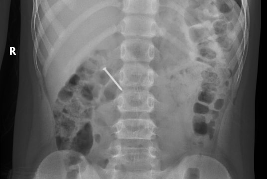 Bé trai 9 tuổi nuốt phải đinh sắt