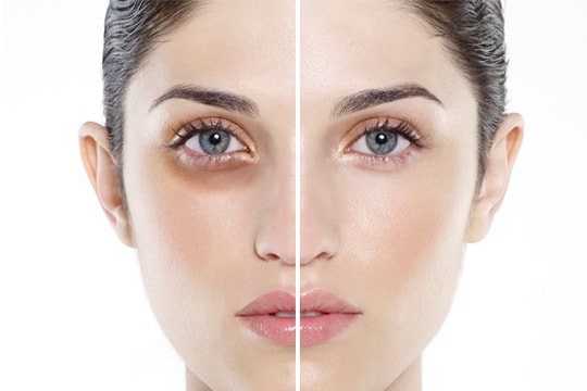 Cách khắc phục mắt thâm quầng khi thức khuya xem World Cup