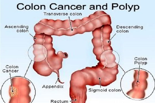 Tầm soát ung thư đại trực tràng thế nào là đúng