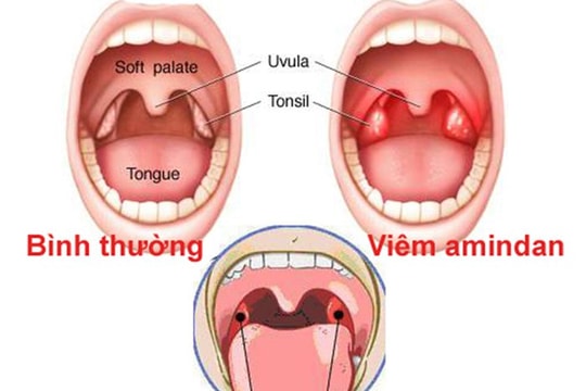 Tại sao không nên cắt amidan nếu chưa cần thiết?