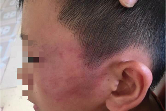 Xác minh vụ bé trai 12 tuổi nghi bị mẹ kế đánh