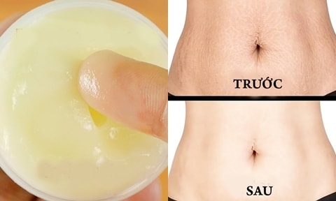 Trị vết rạn da hiệu quả với hỗn hợp lô hội và dầu dừa