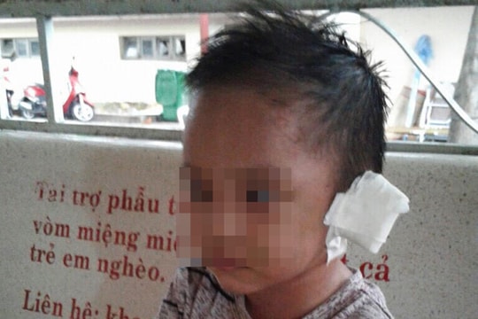 Bé 3 tuổi nghi bị mẹ và 'cha dượng' bạo hành