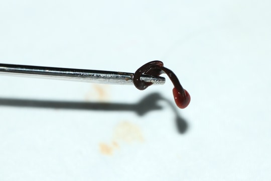 Ký sinh trùng sống 15 ngày trong mũi cụ già 70 tuổi