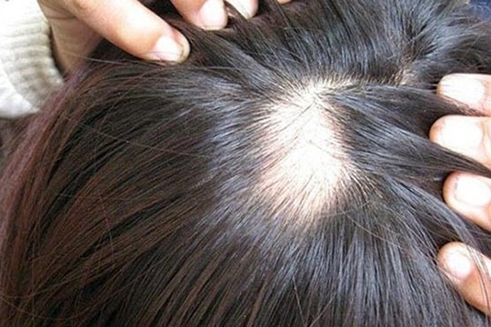 Rụng tóc, hói đầu không còn là nỗi lo với 5 phương pháp đơn giản