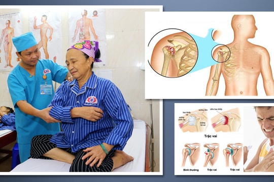 Điều trị viêm quanh khớp vai bằng phương pháp phục hồi chức năng