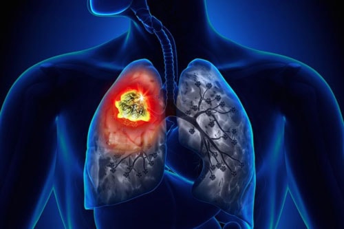 8 dấu hiệu cảnh báo phổi bạn có vấn đề