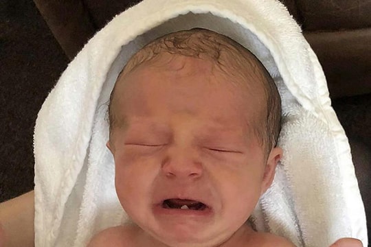 Bé sơ sinh phải nhổ răng khi mới 12 ngày tuổi