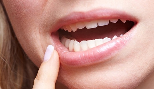 8 dấu hiệu ung thư miệng không nên bỏ qua