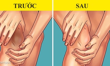 Mẹo làm trắng đầu gối thâm đen từ nguyên liệu rẻ tiền