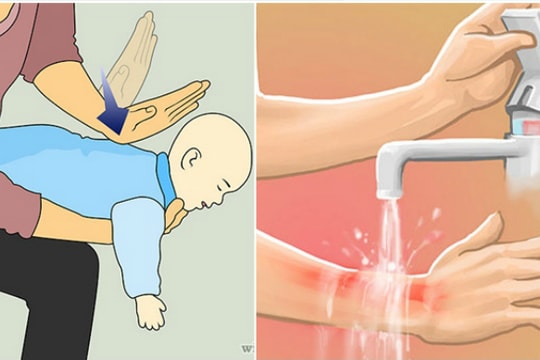 Sai lầm khi sơ cứu đa số người mắc phải