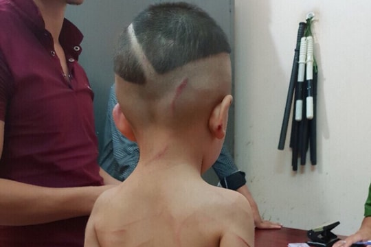 Bắt giam cha dượng bạo hành dã man con riêng 3 tuổi của vợ