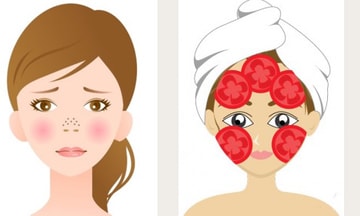 10 nguyên liệu rẻ tiền có tác dụng trị mụn