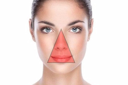 Tại sao không được nặn mụn ở vùng “tam giác chết”?