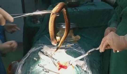 Người đàn ông nuốt lươn sống dài 30 cm để 'chữa' đau dạ dày