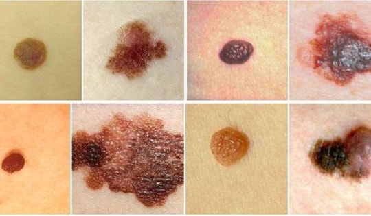 5 dấu hiệu từ nốt ruồi cần nghĩ ngay tới ung thư