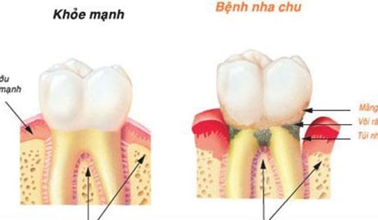 Đánh răng sai cách - nguyên nhân gây ra nhiều bệnh ung thư