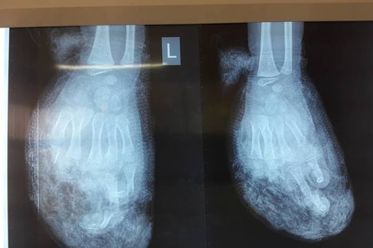 Nghệ An: Cháu bé 7 tuổi bị nát bàn tay do nổ điện thoại 