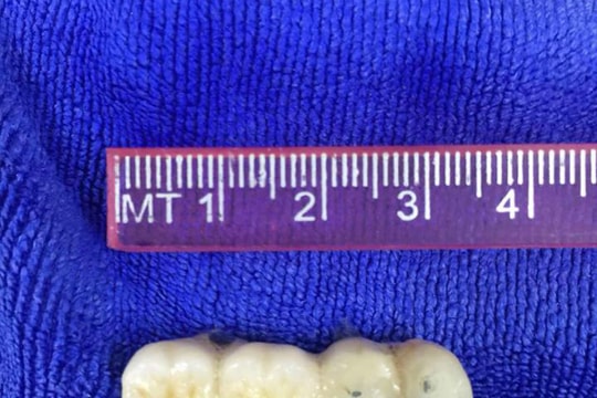 Cầu răng giả rơi vào phế quản cụ ông 90 tuổi