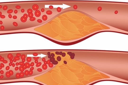 6 thói quen khiến mạch máu dễ tắc nghẽn bạn nên từ bỏ