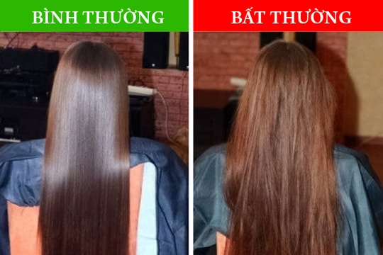 8 vấn đề sức khỏe tiết lộ qua tình trạng mái tóc của bạn