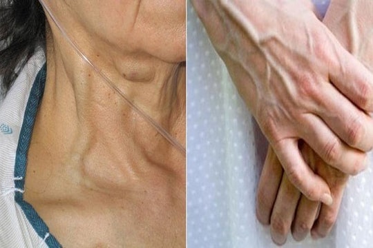 Cơ thể nổi gân xanh cảnh báo điều gì về sức khỏe?