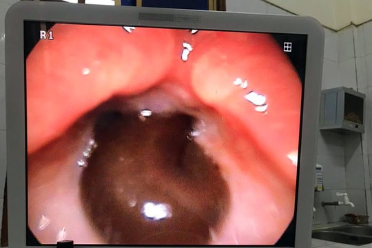 Kinh hoàng đỉa chui vào đường thở cháu bé 9 tuổi ở Nghệ An