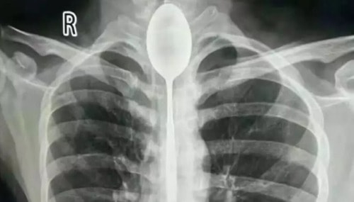 Chiếc thìa kẹt một năm trong thực quản người đàn ông