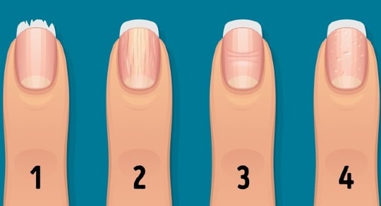13 dấu hiệu ở móng tay cảnh báo vấn đề sức khỏe nghiêm trọng