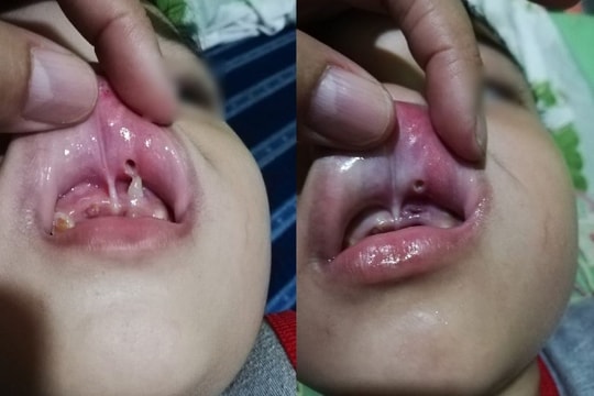 Bé trai bị chiếc răng mọc ngược đâm thủng môi thành lỗ lớn