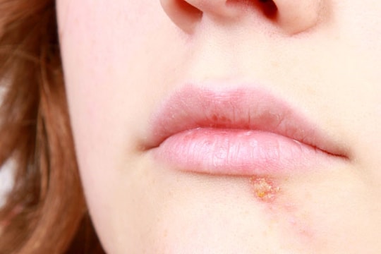 Môi nứt nẻ tiết lộ gì về sức khỏe?