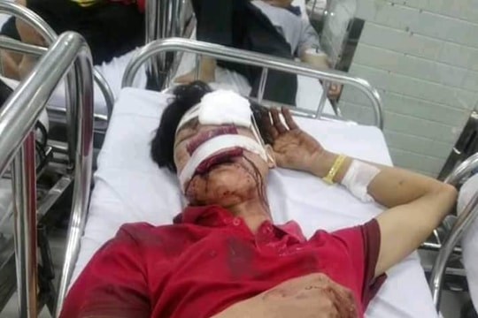 Ván gỗ bật vào mặt, một  lao động Nghệ An bị thương nặng