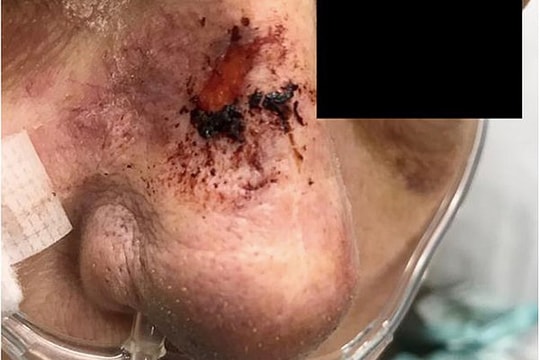 Người phụ nữ tử vong sau khi dùng nước rửa mũi chữa viêm xoang