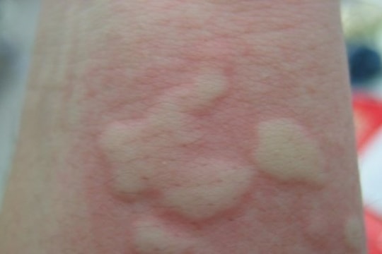 Nổi mề đay khi trời trở lạnh và những cảnh báo