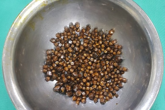 Gần 400 viên sỏi lèn chặt trong túi mật người phụ nữ