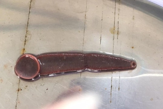 Gắp con đỉa sống 3 tháng trong mũi của bệnh nhân