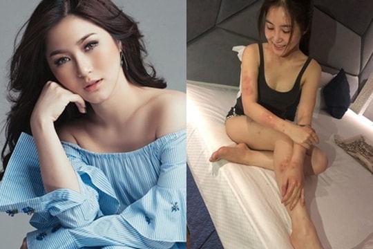 Ca sĩ Hương Tràm nổi mẩn đỏ khắp người vì dị ứng cấp tính