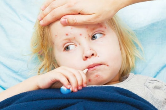 Dấu hiệu nhận biết sớm của bệnh sởi thể ác tính