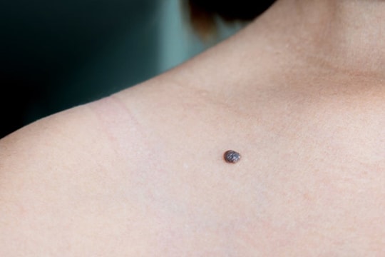 7 dấu hiệu cho thấy ung thư đang nhen nhóm bạn không thể bỏ qua