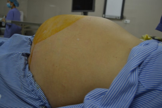 Tưởng béo bụng hóa u buồng trứng khổng lồ
