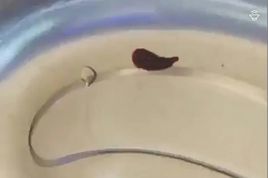 Nghệ An: Phát hiện con vắt dài 5cm sống trong mũi người phụ nữ 57 tuổi