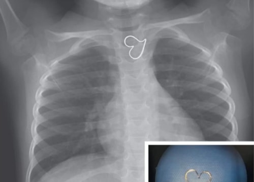 'Trái tim vàng' trên ảnh X-quang của bé gái