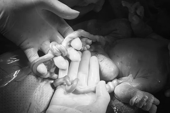 Cặp song sinh chào đời với hai dây rốn cùng thắt nút