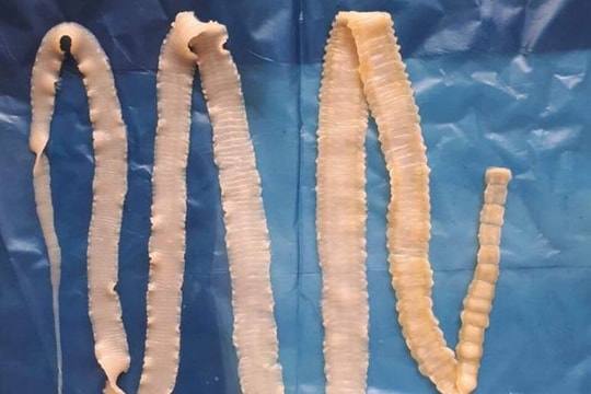 Ăn thịt lợn gạo, sán tấn công cơ thể thế nào?