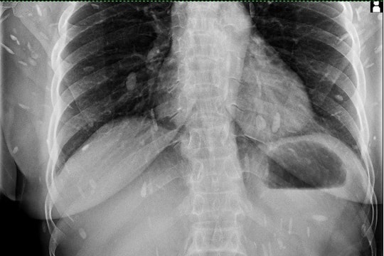 Phát hiện người nhiễm sán lá gan lớn tại Bệnh viện Hoàn Mỹ Quốc tế Vinh